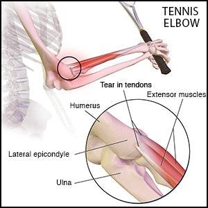 Diagram illustrating tennis elbow anatomy and affected areas.