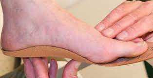 Custom foot orthotics fitting and assessment.
