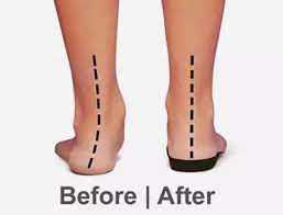 Before and after effects of custom foot orthotics on alignment.